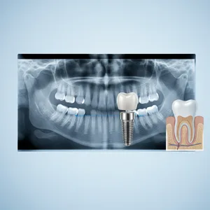 Studio odontoiatrico Minutoli - implantologia