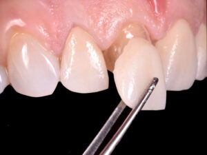 minutoli-faccetta-dentale