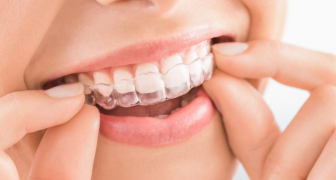 minutoli-invisalign